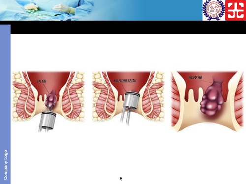 sug-crs-2痔核橡皮圈結紮術後注意事項.pptx